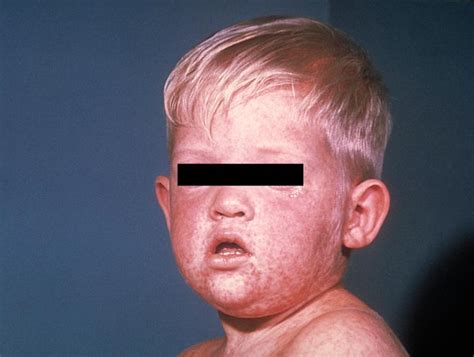 Measles Physical Examination Wikidoc