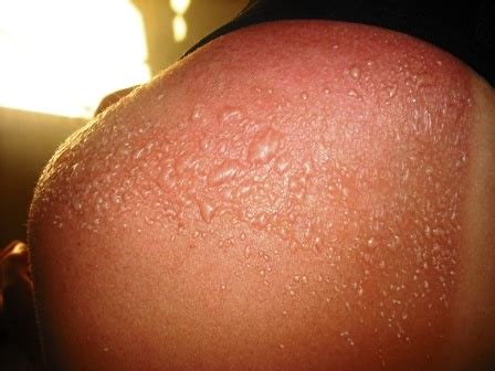 Such edema (swelling) is quite normal after a severe sunburn. Why do some people develop rashes from their own sweat ...