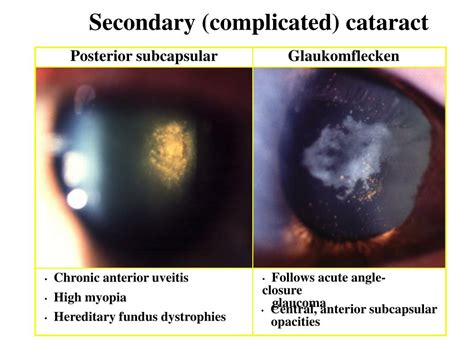 Ppt Ophthalmology Cataracts Powerpoint Presentation Free Download