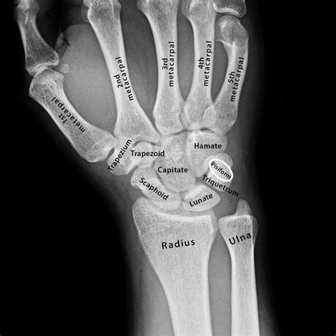Lateral Wrist X Ray Anatomy