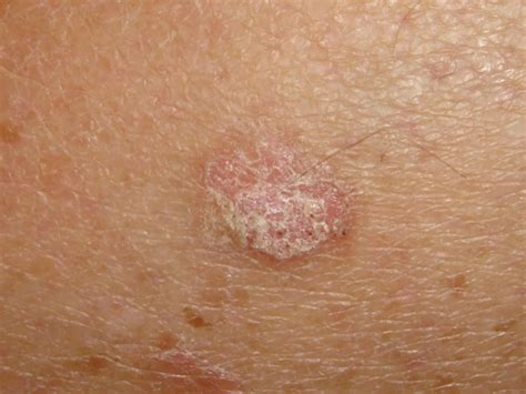 Symptoms And Causes Of Seborrheic Keratosis You Should Know About