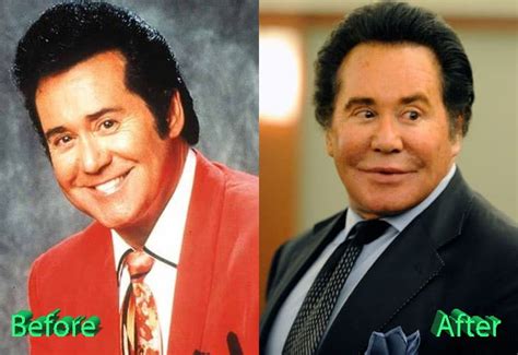 Wayne Newton Before And After Plastic Surgery Celebrity Plastic Surgery