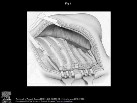 Thoracoplasty In The Current Practice Of Thoracic Surgery A Single