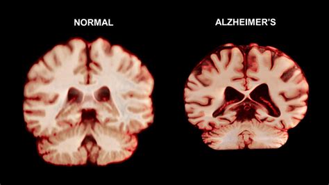 Normal Brain Vs Alzheimers Disease Photograph By Anatomical Travelogue