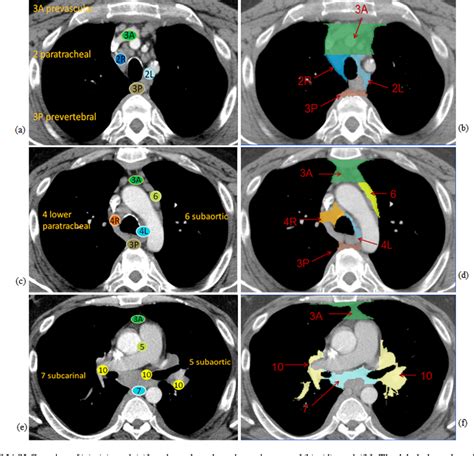 Figure 2 From Mediastinal Lymph Node Detection And Station Mapping On