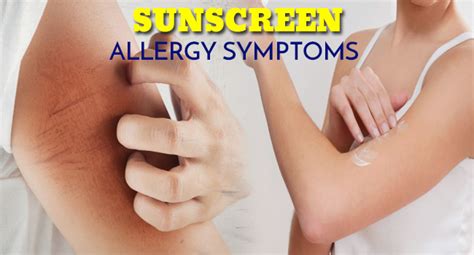 Sunscreen Allergy Symptoms Allergy