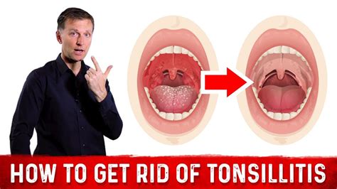 How To Get Rid Of Painful Swollen Tonsils Tonsillitis Dr Berg