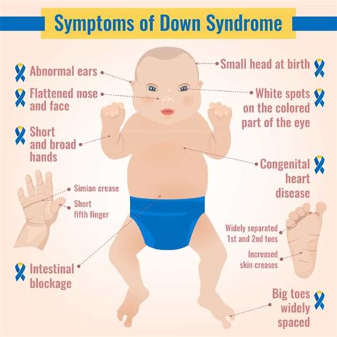 Everything You Need To Know About Down Syndrome Overview Signs And