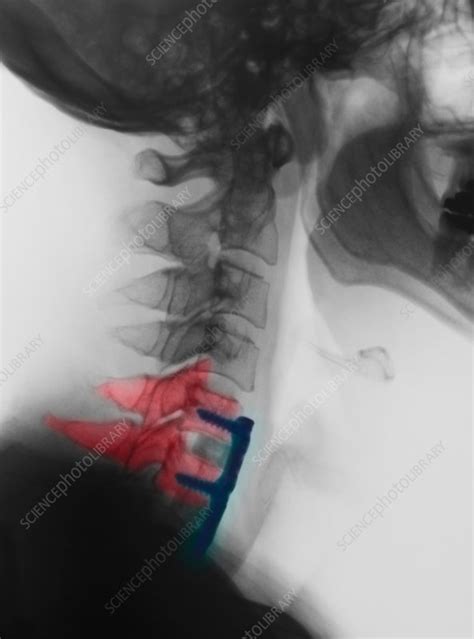 Cervical Xray Showing Spinal Fusion C5 C6 C7 Stock Image F018