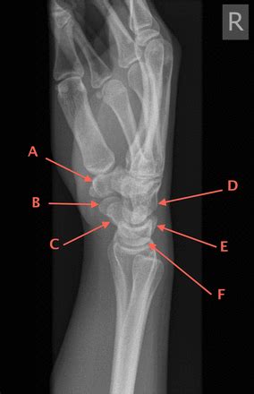 Carpal Bone Anatomy X Ray