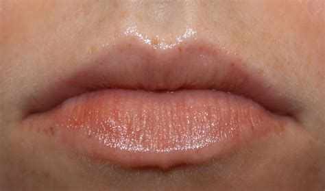 Allergic Reaction On Lips Eczema On The Lips Types Triggers Causes