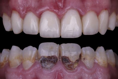 Smile Makeover With Direct Composite Veneers