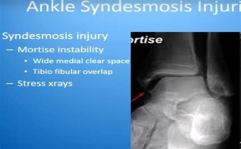 Ankle Syndesmotic Injuries —
