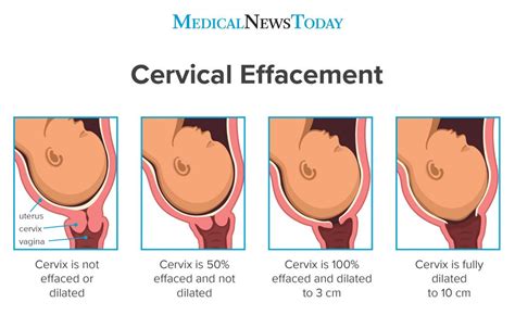 Cm Cervix Dilation