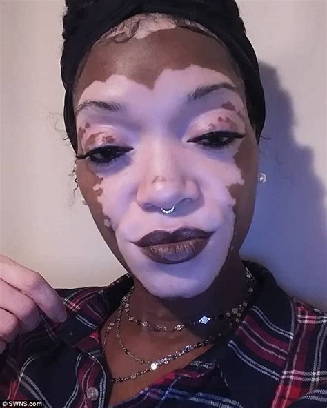 Woman With Heart Shaped Vitiligo Patch On Her Face Goes Makeup Free