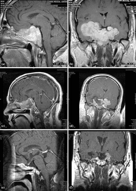 Sagittal And Coronal T1 Weighted Mr Image Of Giant Skull Base Tumor