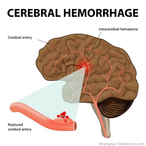 Subarachnoid Hemorrhage Vs Intracerebral Hemorrhage