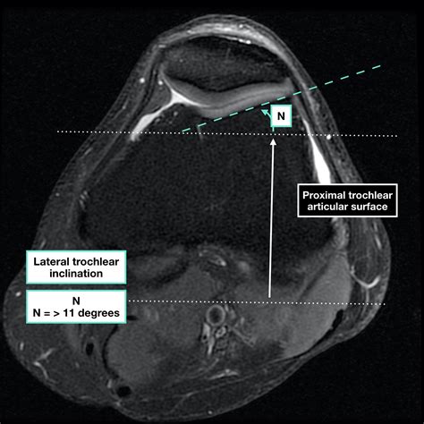 Radiological Measurements In Patellar Instability Docjointsdr Sujit