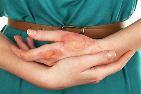 What To Do If You Get Burned Wellcare