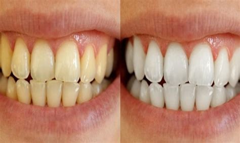 Gigi kuning bisa menurunkan kepercayaan diri khususnya ketika berbicara dengan orang lain. 7 Cara Putihkan Gigi Dengan Selamat & Semulajadi, Tak ...