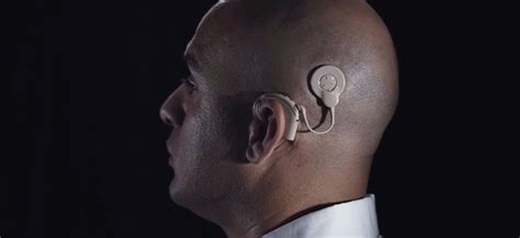 Case Study How A Cochlear Implant Helped Restore Hearing Med Tech