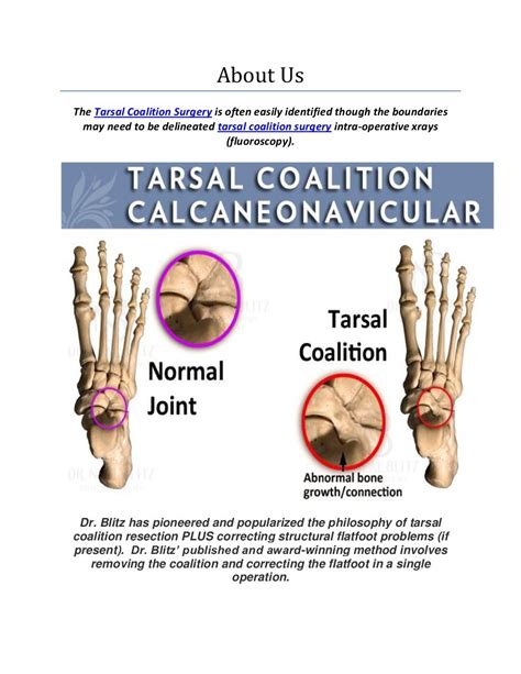 Tarsal Coalition Surgery