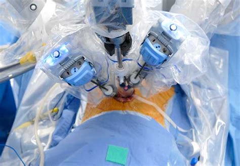 Radical Prostatectomies Mostly Performed Robotically Renal And Urology News