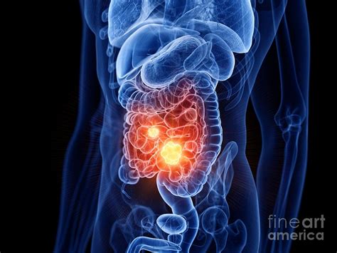 small intestine cancer photograph by sebastian kaulitzki science photo library fine art america