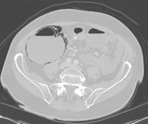 Impressive Pneumatosis Coli In 3d Colon Case Studies Ctisus Ct Scanning