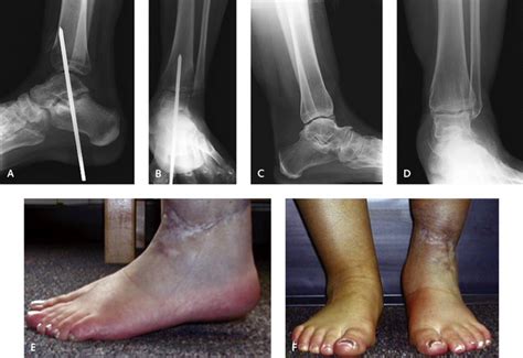 Reconstruction Of Malunited Ankle Fractures Plastic Surgery Key