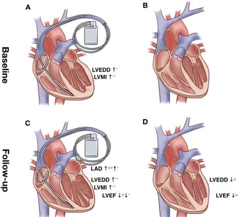 Effects Of Long Term Right Ventricular Apex Pacing On Left Ventricular