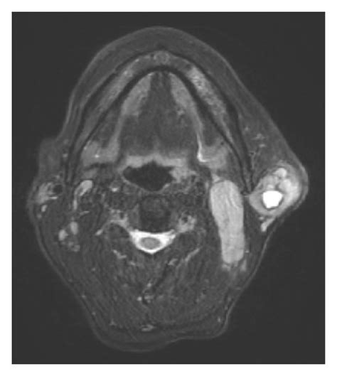A B A Ct Scan Demonstrated A Nodular Isodense And Necrotic Mass In