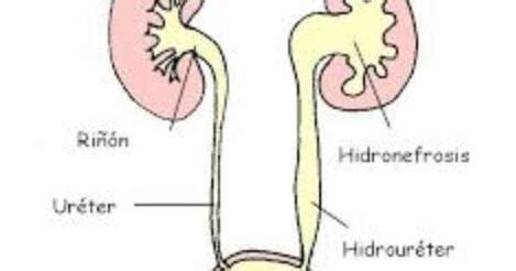 This video is on causes, symptoms, tips to prevent avoid them naturally even when sexually active. Welcome to my blog : Hydronefrosis with Renal and Ureteral ...