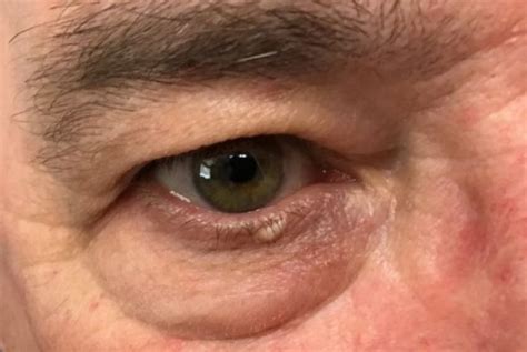Case Study White Papule Under The Eye Dermatology Advisor