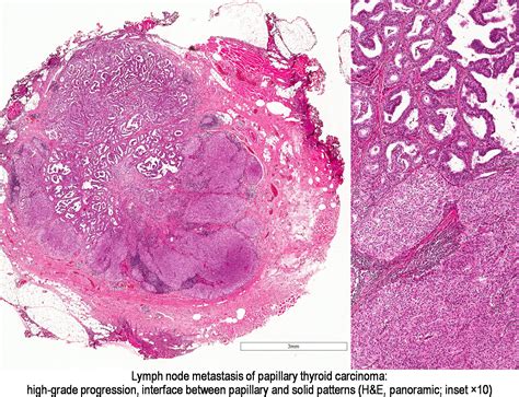 Pathology Outlines Papillary Thyroid Carcinoma Overview