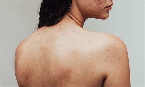 Body Acne Guide Causes And How To Get Rid Of It Software