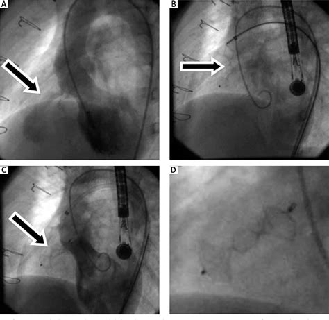 Figure 1 From Transcatheter Closure Of Ventricular Septal Defects With