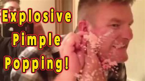 Disgusting Pimple And Cyst Popping Very Explosive Youtube
