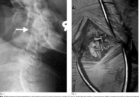 Figure 2 From Cervical Stenosis And Spastic Quadriparesis In Morquio Disease Mps Iv A Case