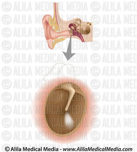 Alila Medical Media Anatomia Do Tímpano Ilustração Médica