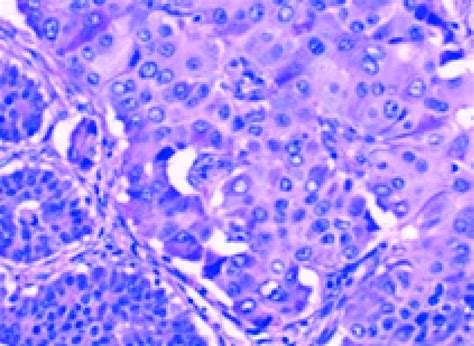 Tumor Cells Show Oval Or Round Central Nuclei And An Abundant Granular