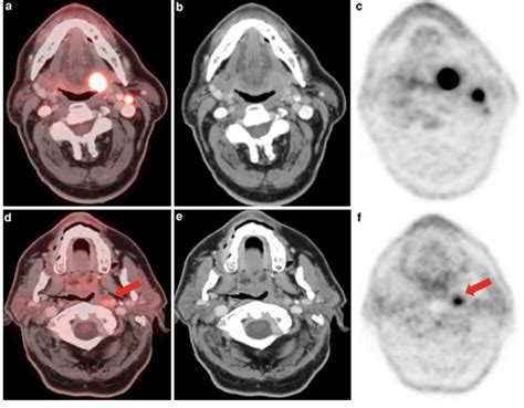 Nodal Staging Retropharyngeal Node A D Petdct B E Contrast