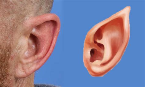Fixing Elf Ears World Expert In Making Ears Smaller