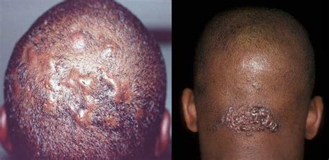 Ingrown Hair On Scalp Is No Abnormal Skin Condition Especially For Men
