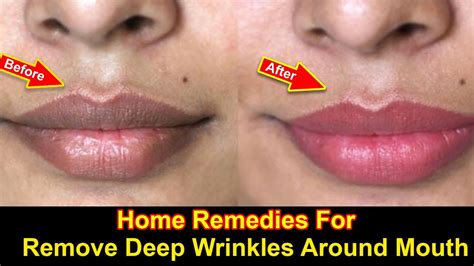 Home Remedies Remove Deep Wrinkles Around Mouth Youtube
