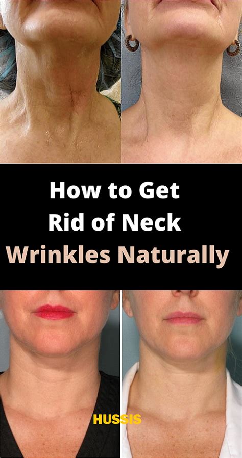 How To Get Rid Of Neck Wrinkles Naturally In 2022 Neck Wrinkles