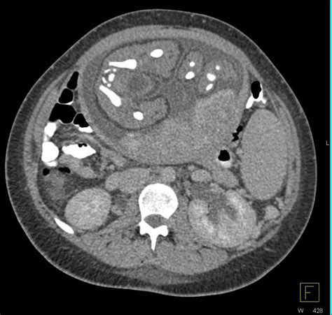 Acute pyelonephritis in pregnancy is a diagnosis made without the support of imaging. Acute Pyelonephritis in a Pregnant Patient - Kidney Case ...