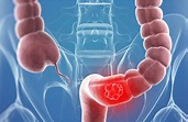 Cáncer colo-rectal – Clínica Pueyrredon