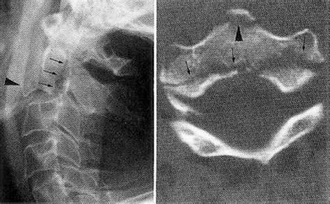 Fractures Of The C 2 Vertebral Body In Journal Of Neurosurgery Volume