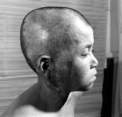 Hiroshima Photos Of Survivors Of The Worlds First Atomic Attack